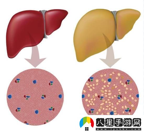 大學(xué)生月瘦20斤卻患上脂肪肝